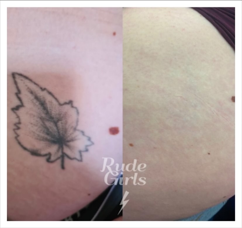 Portfolio de Rudegirls Laser Tattoo Removal