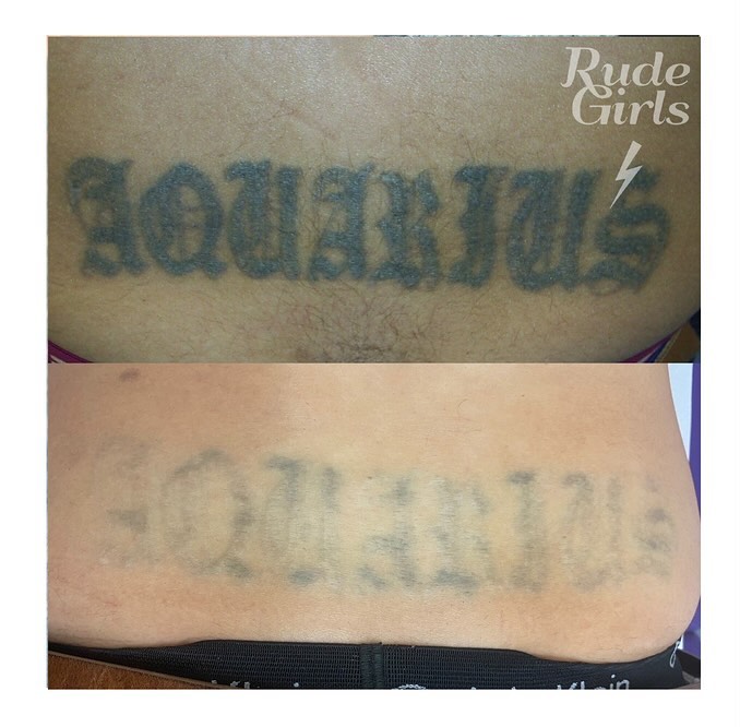 Portfolio de Rudegirls Laser Tattoo Removal