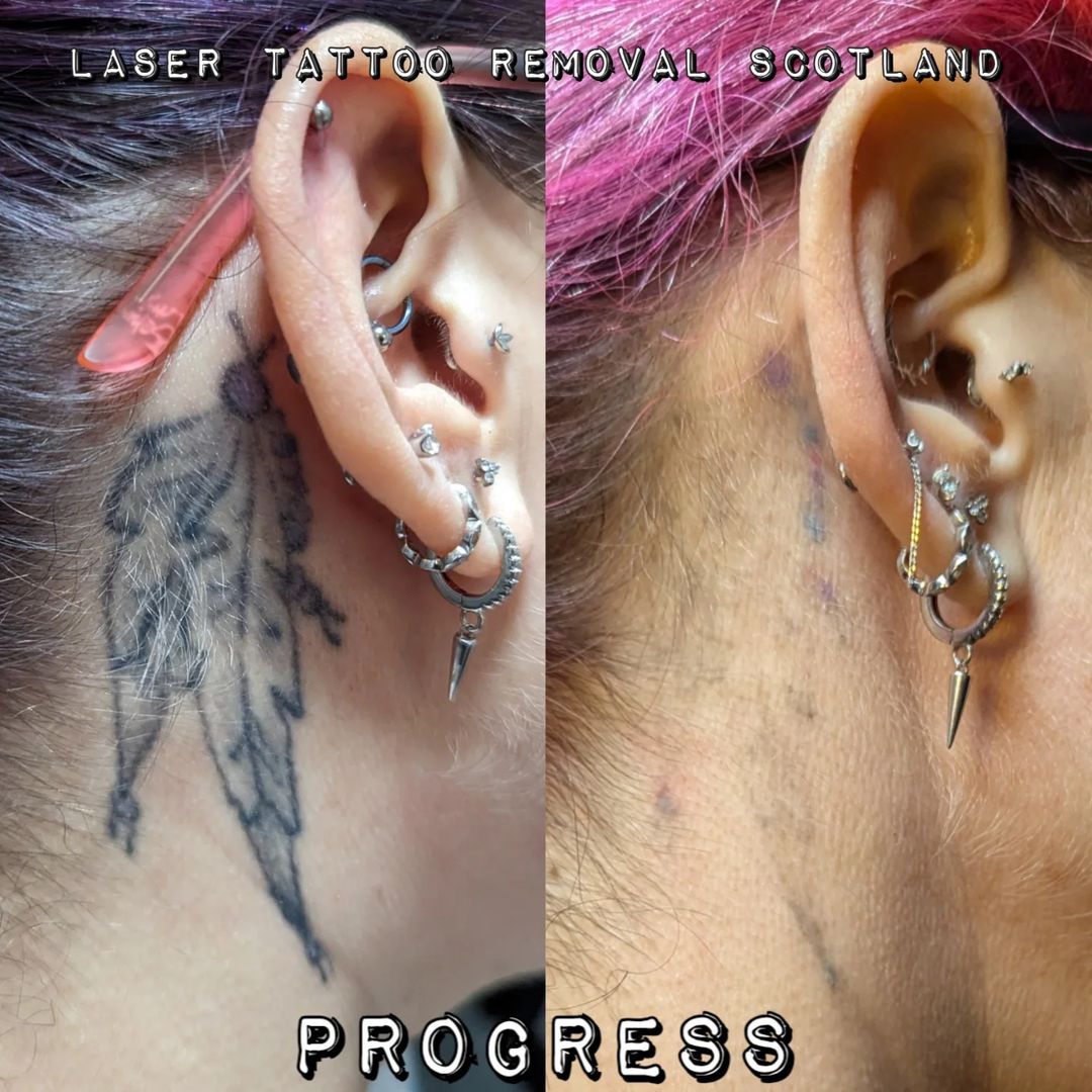 Tatouage par Laser Tattoo Removal Scotland