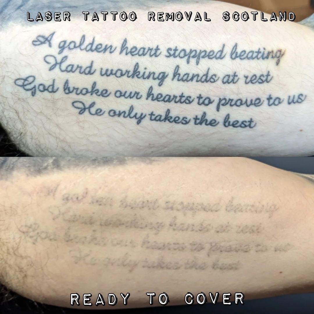 Tatouage par Laser Tattoo Removal Scotland