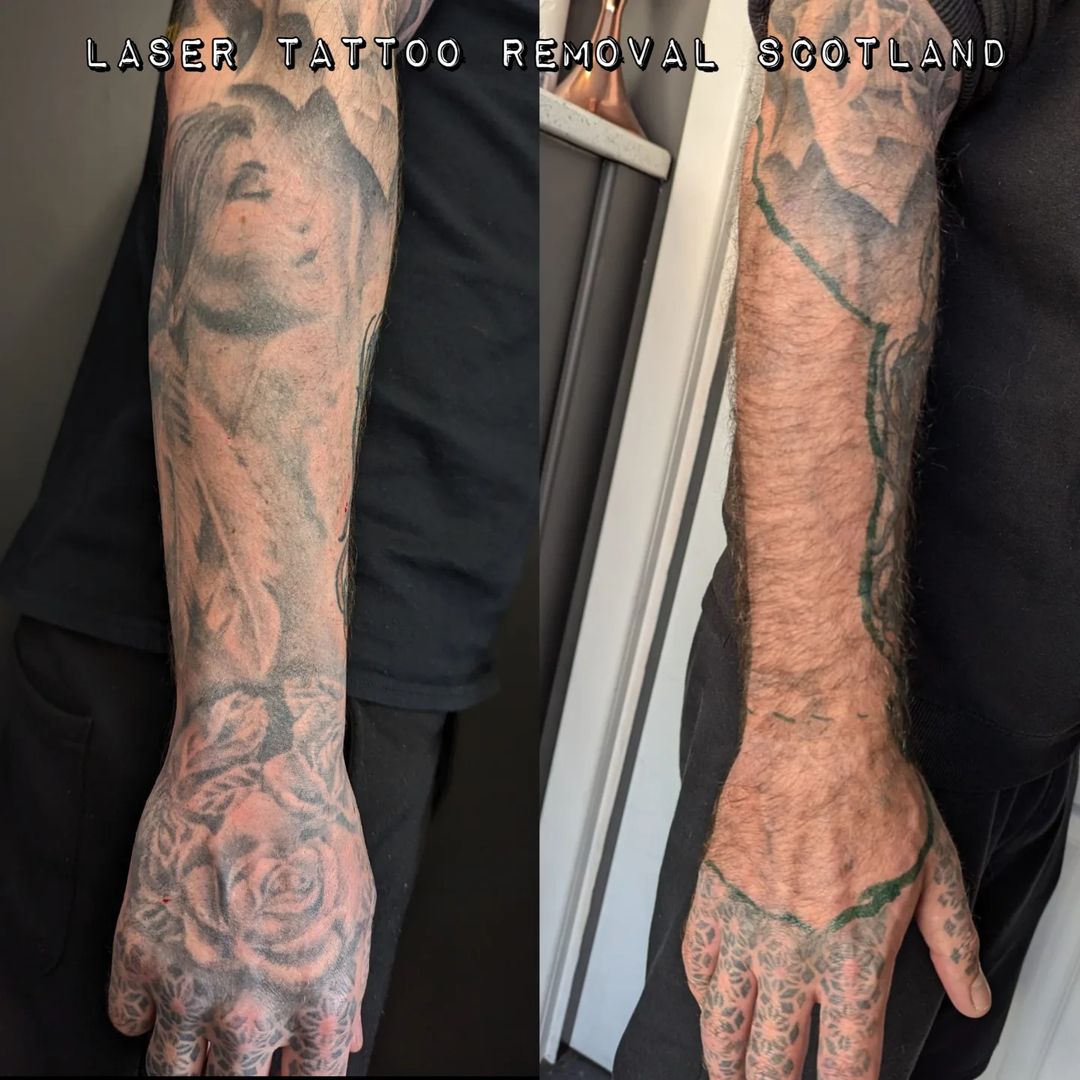 Portfolio de Laser Tattoo Removal Scotland