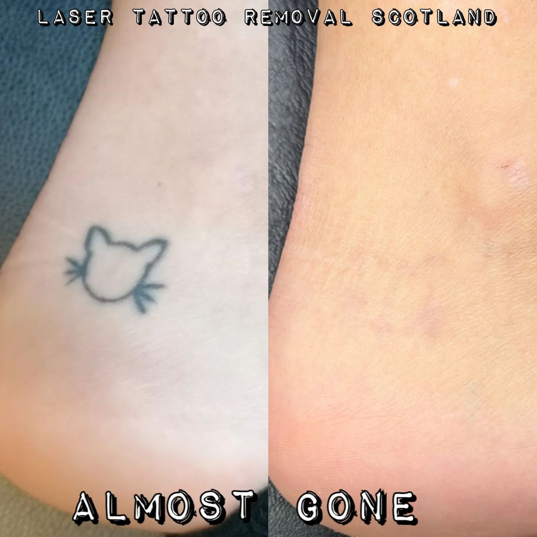 Portfolio de Laser Tattoo Removal Scotland