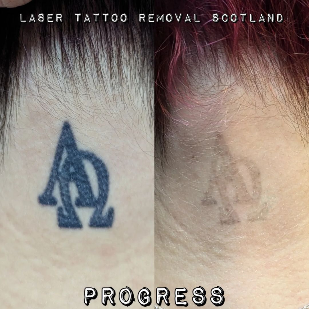 Portfolio de Laser Tattoo Removal Scotland