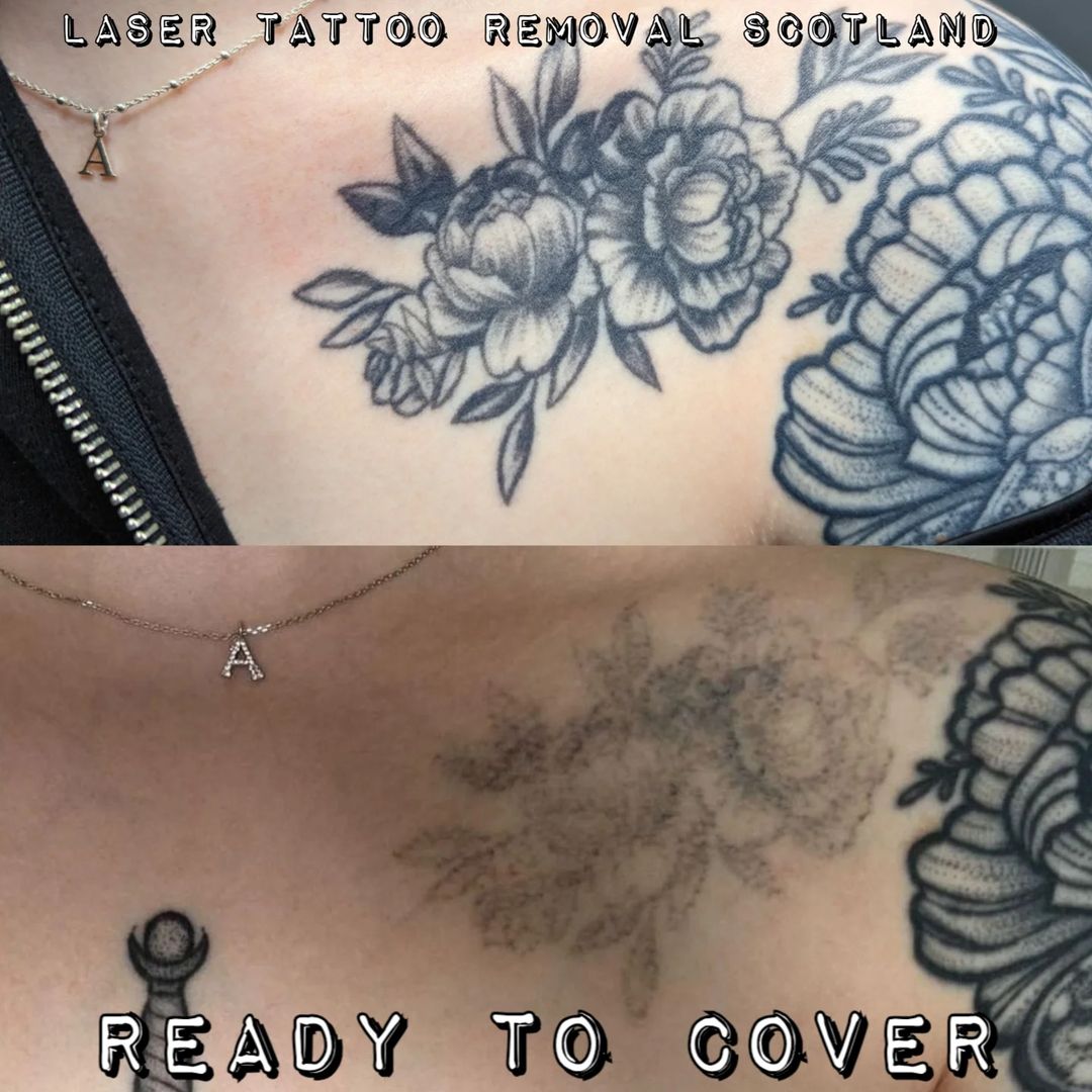 Portfolio de Laser Tattoo Removal Scotland
